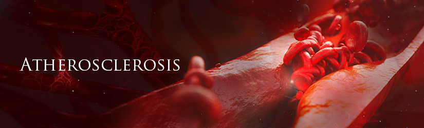 Atherosclerosis