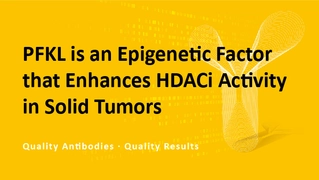 PFKL is an Epigenetic Factor that Enhances HDACi Activity in Solid Tumors