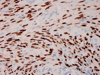 Anti-KSHV ORF73 antibody [HHV8/3606] used in IHC (Paraffin sections) (IHC-P). GTX02773