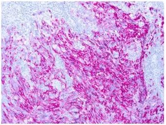 Anti-Melanoma antibody [PNL2] used in IHC (Paraffin sections) (IHC-P). GTX12502