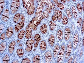 Anti-Colorectal adenocarcinoma antibody [C241:5:1:4] used in IHC (Paraffin sections) (IHC-P). GTX17252