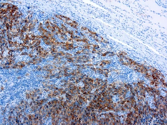 Anti-Melanoma antibody [HMB45] used in IHC (Paraffin sections) (IHC-P). GTX20787