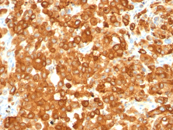 Anti-Melanoma gp100 antibody [HMB45] used in IHC (Paraffin sections) (IHC-P). GTX34833