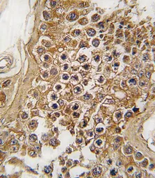 Anti-ALK antibody, Internal used in IHC (Paraffin sections) (IHC-P). GTX81366